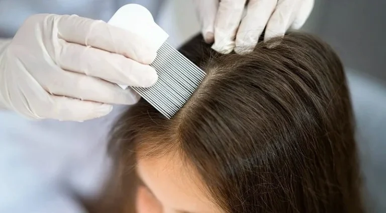 علت ریزش مو در کودکان 9 تا 12 سال