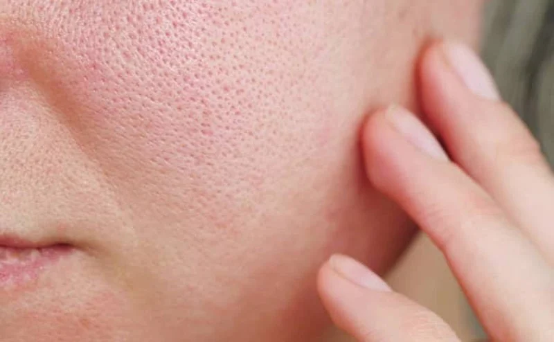 کرم ضد جوش صورت و عوارض آن؛ نکاتی برای استفاده ایمن
