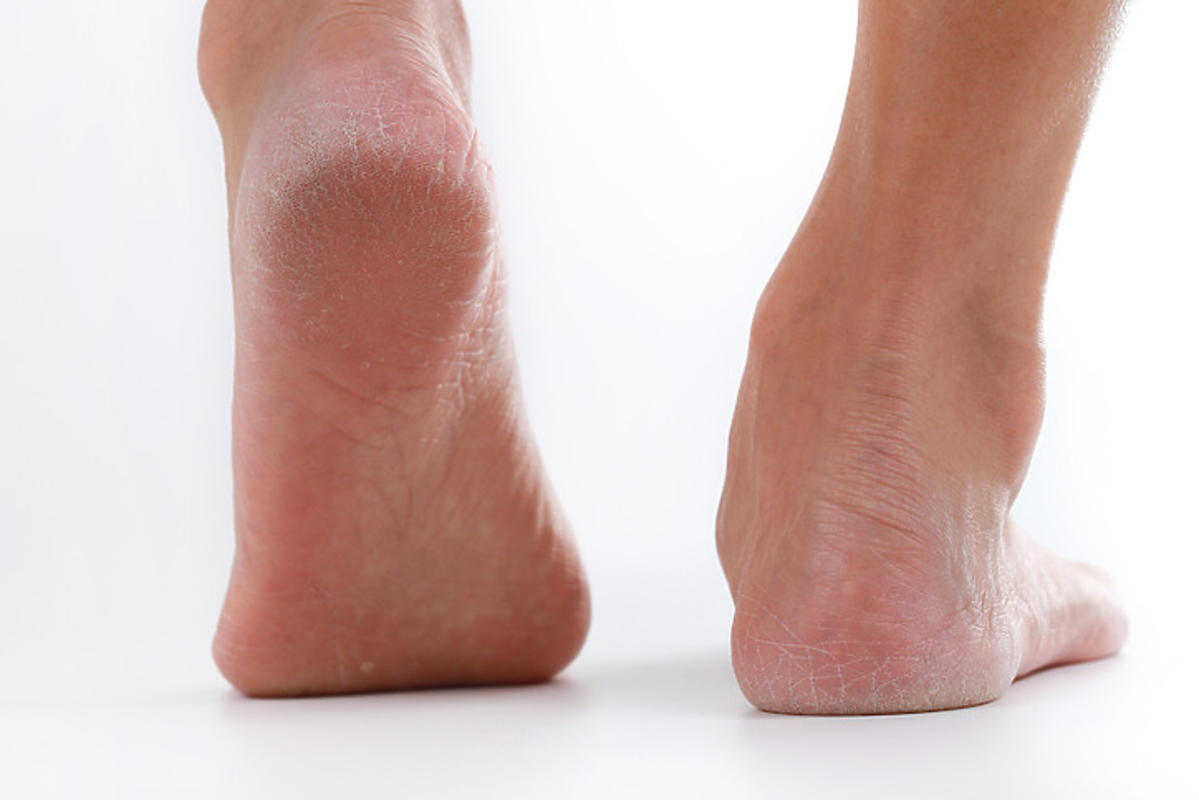 کمبود کدام ویتامین باعث پوسته شدن کف پا میشود؟