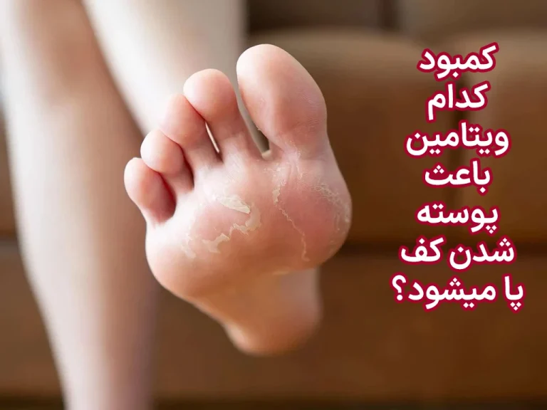 کمبود کدام ویتامین باعث پوسته شدن کف پا میشود؟