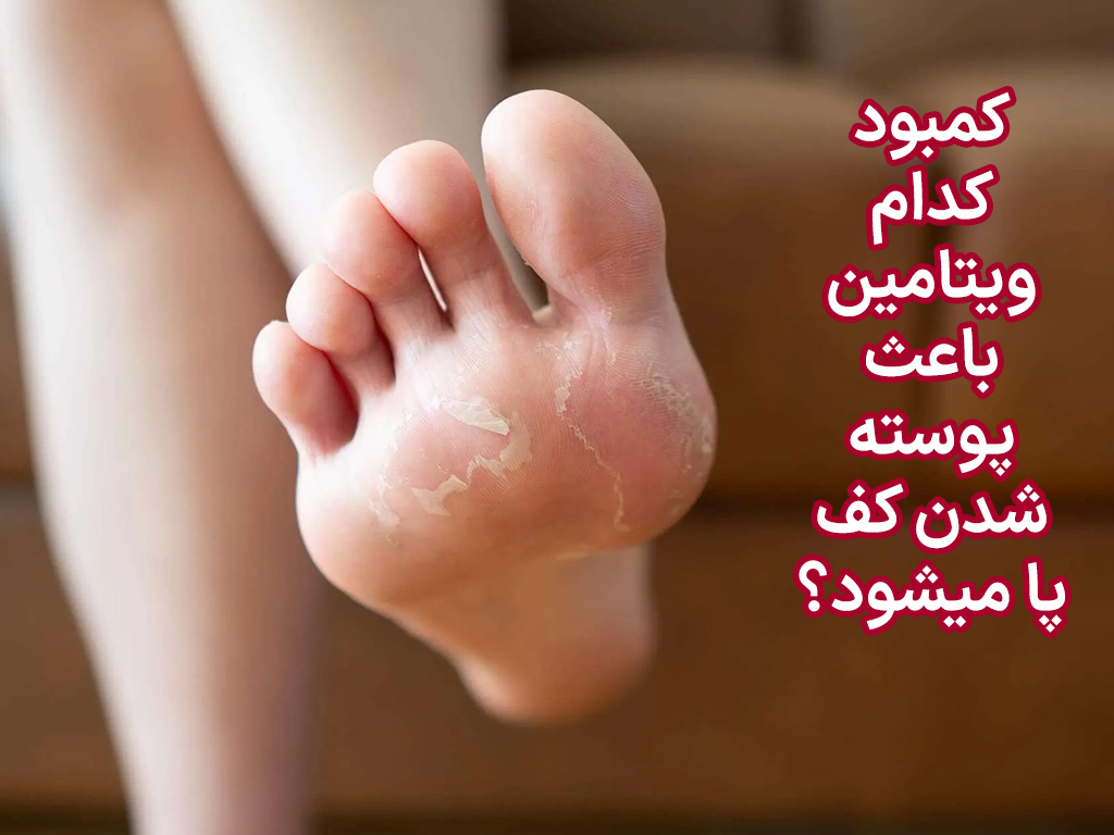 کمبود کدام ویتامین باعث پوسته شدن کف پا میشود؟