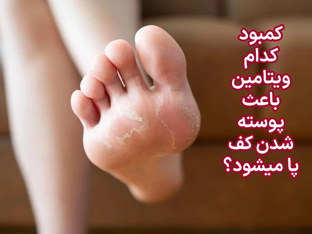 کمبود کدام ویتامین باعث پوسته شدن کف پا میشود؟
