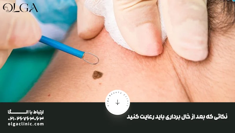 برداشتن خال سطحی صورت در یک روز