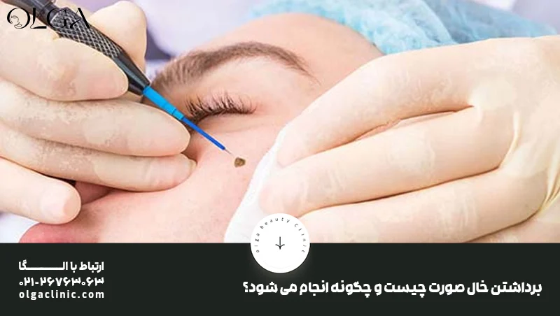 برداشتن خال سطحی صورت در یک روز